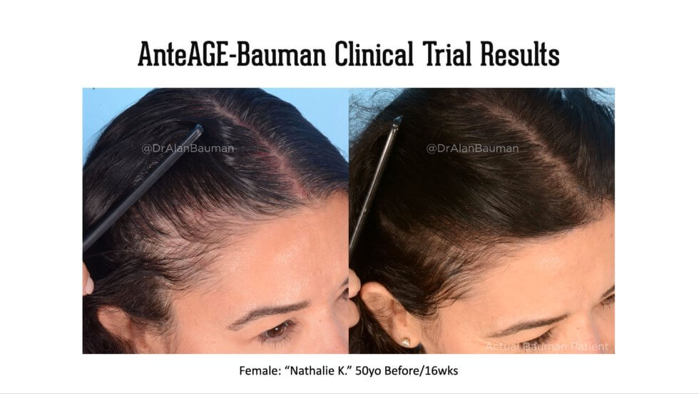 VirtualPRP AnteAGE-MD Clinical Trial Before+After Results · Bauman Medical