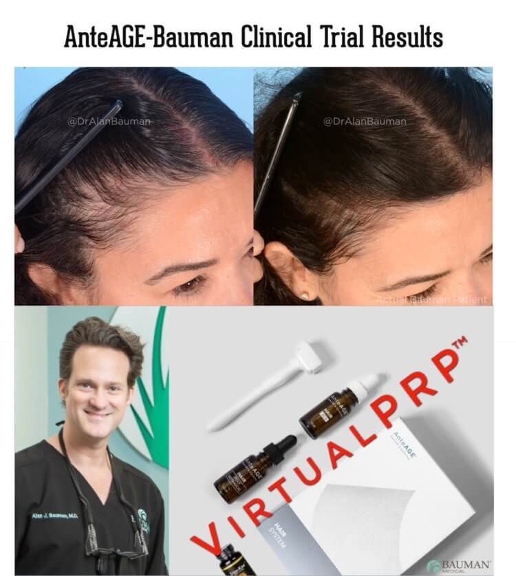 VirtualPRP AnteAGE-MD Clinical Trial Before+After Results