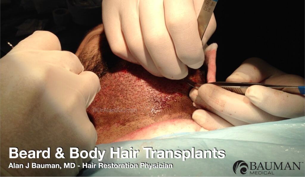 Beard Body Hair Transplant Bht Donor Harvest Fue Dralanbauman