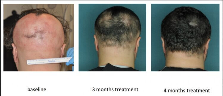 Drug Restores Hair Growth in Alopecia Areata