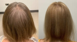 Introducing Alma Ted Transepidermal Delivery For Hair Shedding And Hair Loss - -