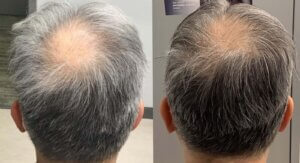 Introducing Alma Ted Transepidermal Delivery For Hair Shedding And Hair Loss - -