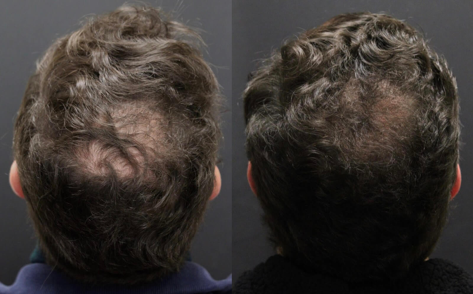 Introducing Alma TED TransEpidermal Delivery For Hair Shedding and Hair Loss · Bauman Medical Introducing Alma TED TransEpidermal Delivery For Hair Shedding and Hair Loss · Bauman Medical