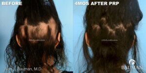 Before And 4 Months After Prp For Alopecia Areata By Dr. Alan Bauman