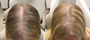 In The Thick Of Hair Loss Awareness Month Top Hair Doctor Introduces Alma Ted: New Breakthrough Non-Invasive Technology To Improve Hair Growth - -