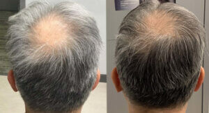 In The Thick Of Hair Loss Awareness Month Top Hair Doctor Introduces Alma Ted: New Breakthrough Non-Invasive Technology To Improve Hair Growth - -