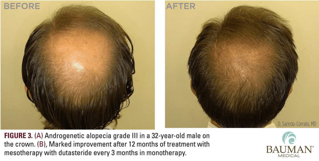 Mesotherapy Dutasteride Results Before-After