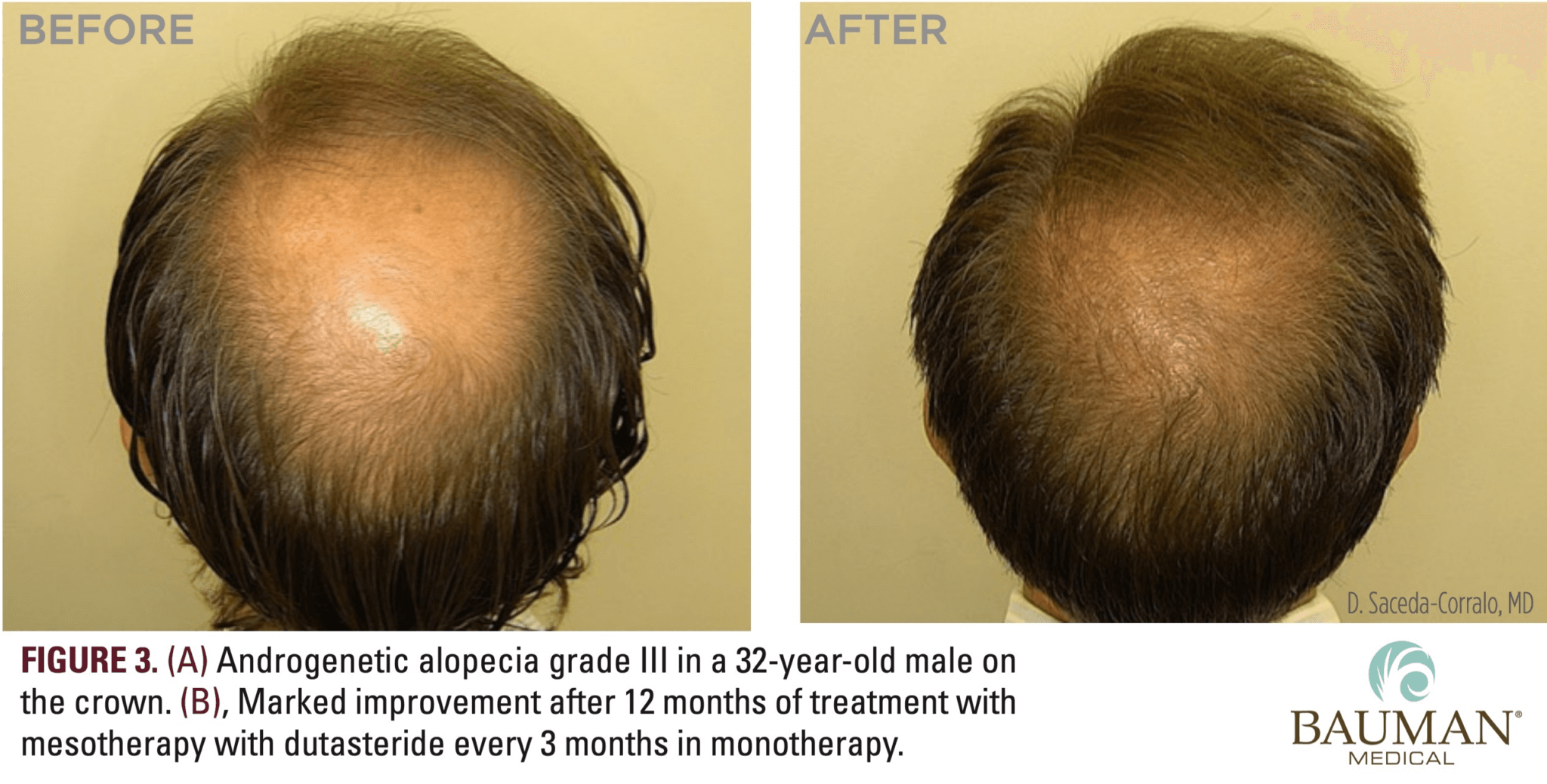 What is Dutasteride Mesotherapy? · Bauman Medical