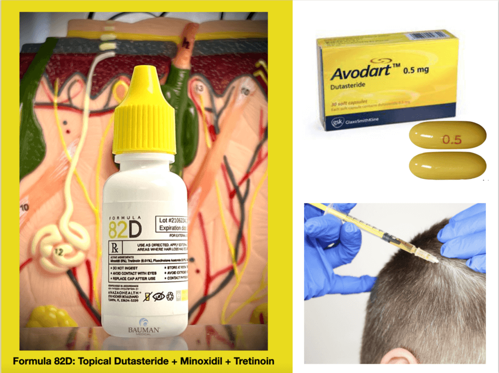 Hair Transplant With and Without Finasteride  Do You Need It