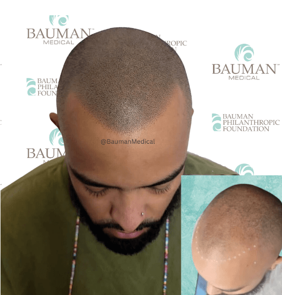 Smp Scalp Micropigmentation - -