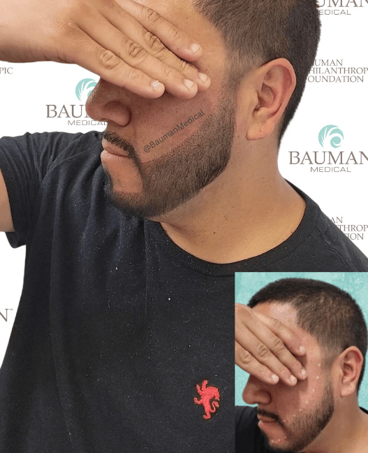 Smp Scalp Micropigmentation - -