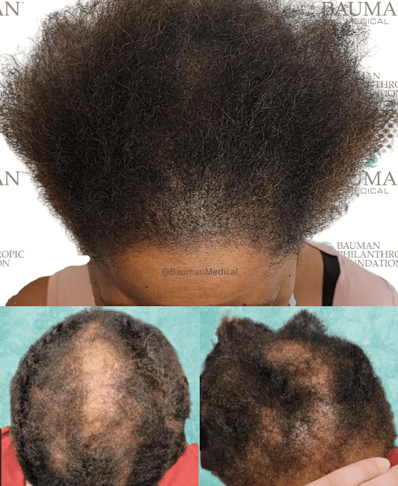 Smp Scalp Micropigmentation - -