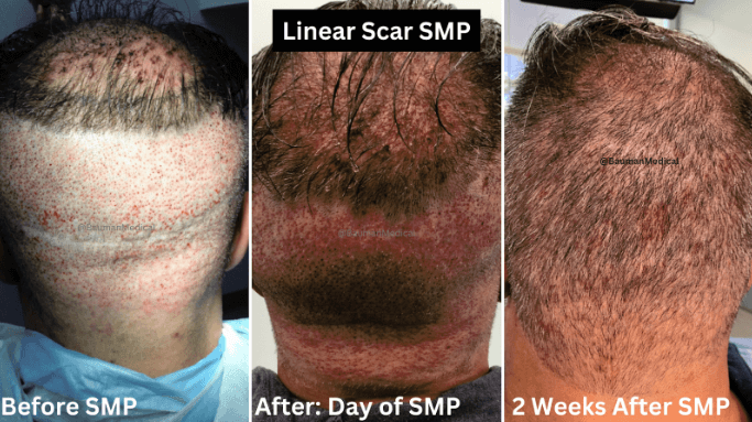 Smp Scalp Micropigmentation - -