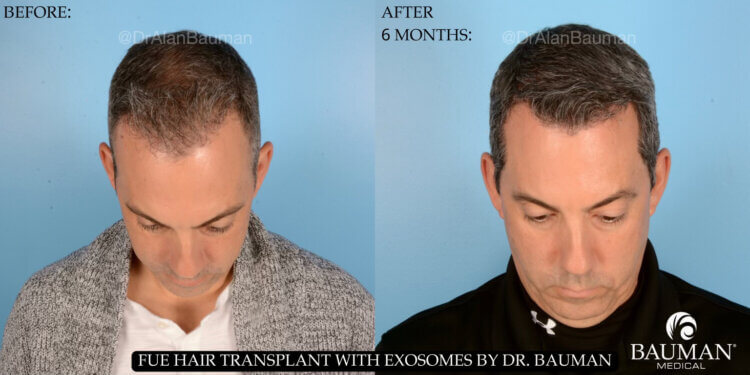 HAIR LOSS AWARENESS MONTH 2024 “TIME EQUALS FOLLICLES”