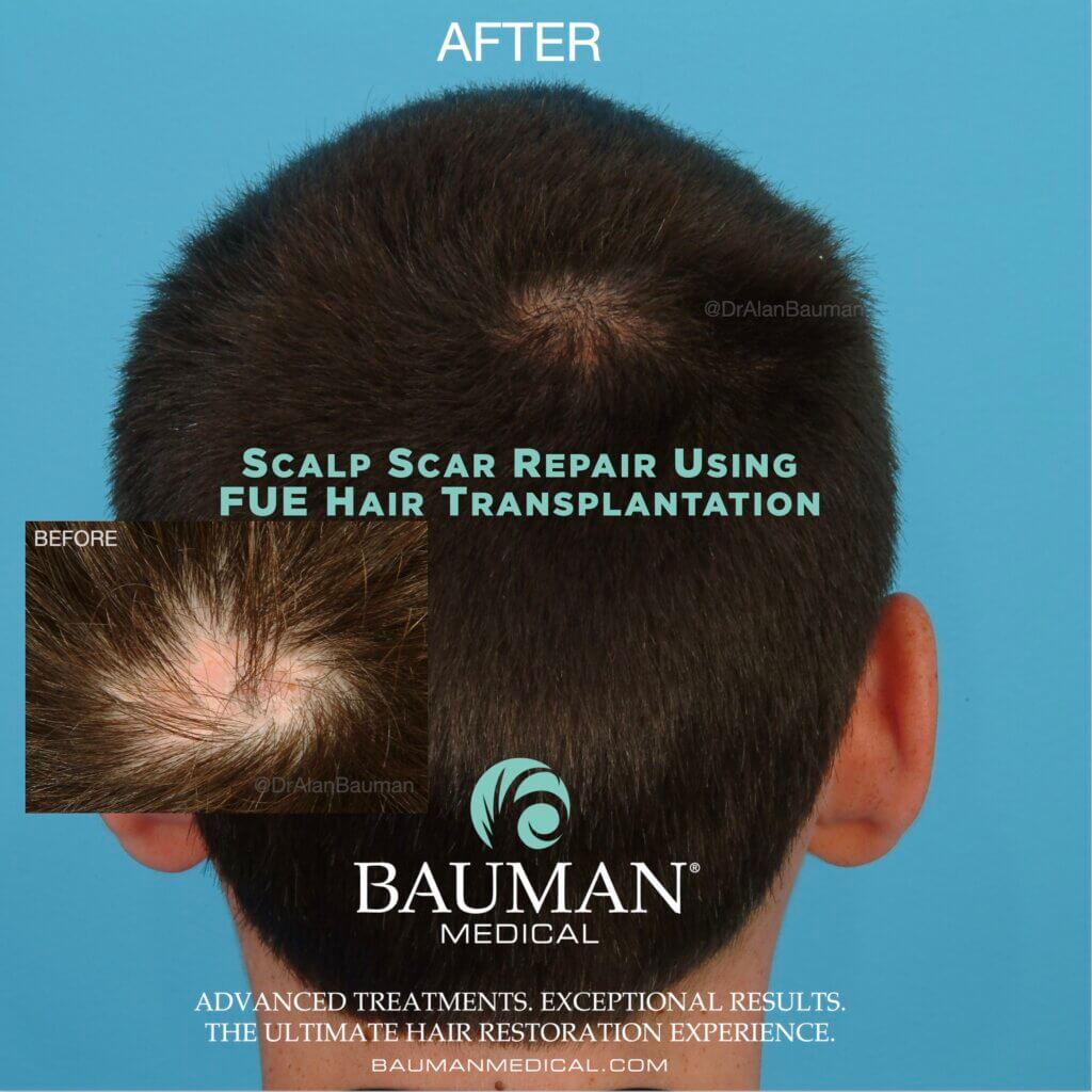 Scalp-Scar-Repair-With-Fue-Dralanbauman