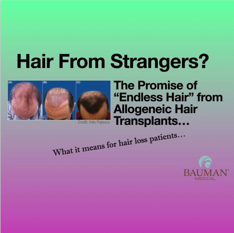 Hair From Strangers? Exploring Allogeneic Hair Transplant Options for an Unlimited Supply of Hair