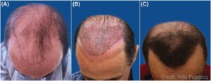 Hair From Strangers? Exploring Allogeneic Hair Transplant Options For An Unlimited Supply Of Hair Drfelix_Allogeneic-Hair-Transplant-From-Another-Person