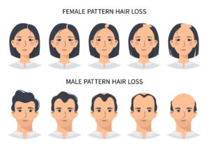hair-loss-stages-androgenetic-alopecia-male-and-female-pattern-steps-of-baldness-infographic-in-a-flat-style-with-a-man-and-a-woman-changing-the-hairline-on-the-scalp-vector