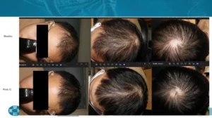 Image: Before-and-after results from GT20029 Phase II clinical trial. Credit: Courtesy of Kintor Pharmaceutical, shared via interview with Reddit user noeyys .